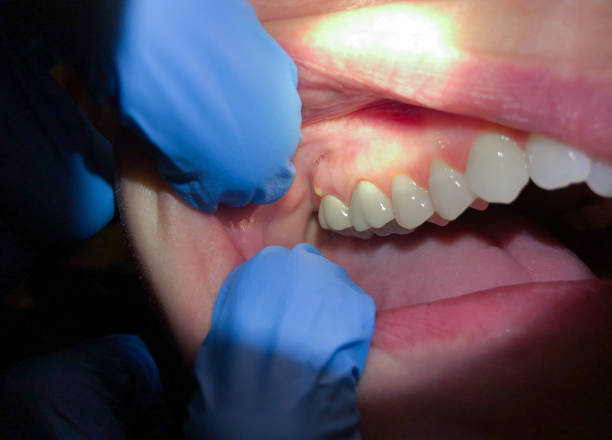 Best Emergency Dentist for Lost Fillings or Crowns in Gowanda, NY